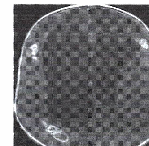 Ressonância magnética axial T1 pós-contraste demonstrando múltiplas lesões com realce anular.