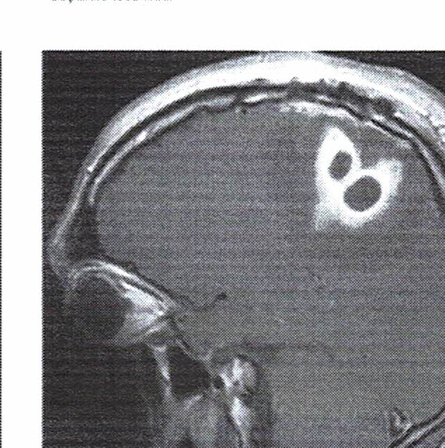 Ressonância magnética sagital T1 pós-contraste demonstrando lesões com realce anular.