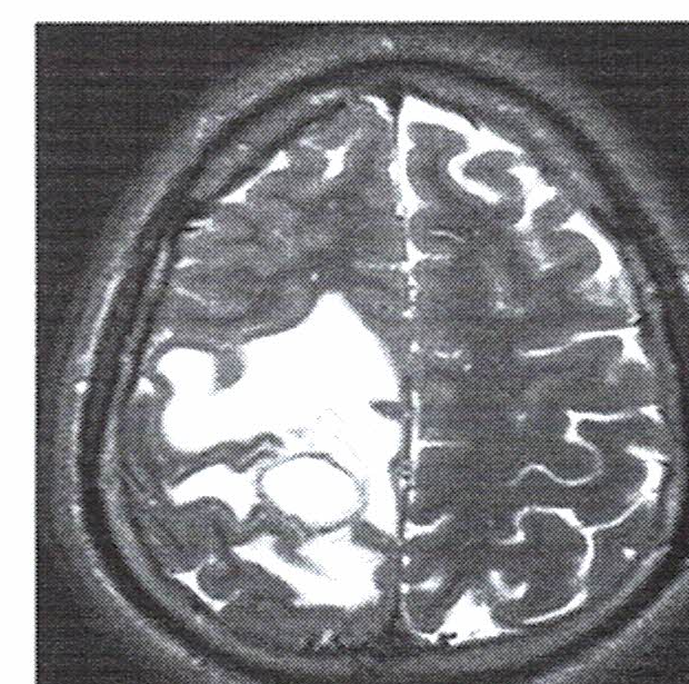 Ressonância magnética axial ponderada em T2 demonstrando edema vasogênico.